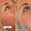 DermaClear™ – Removedor de Verrugas