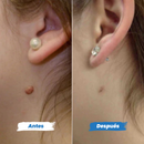 DermaClear™ – Removedor de Verrugas